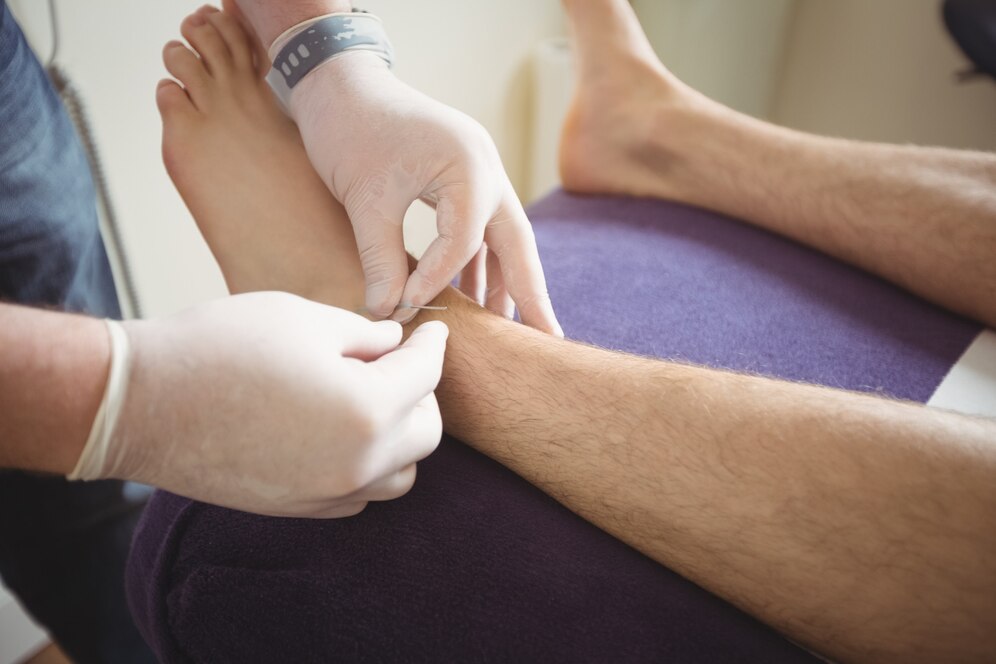 physiotherapist performing dry needling leg patient 107420 65804